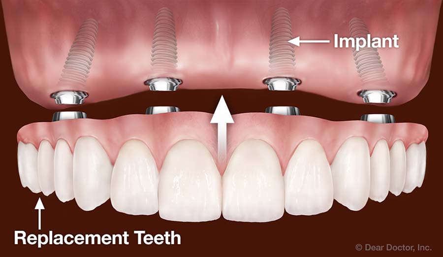 Dental Implants Replace All Teeth.