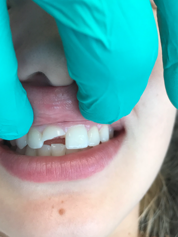 Federici Dental patient with chipped tooth