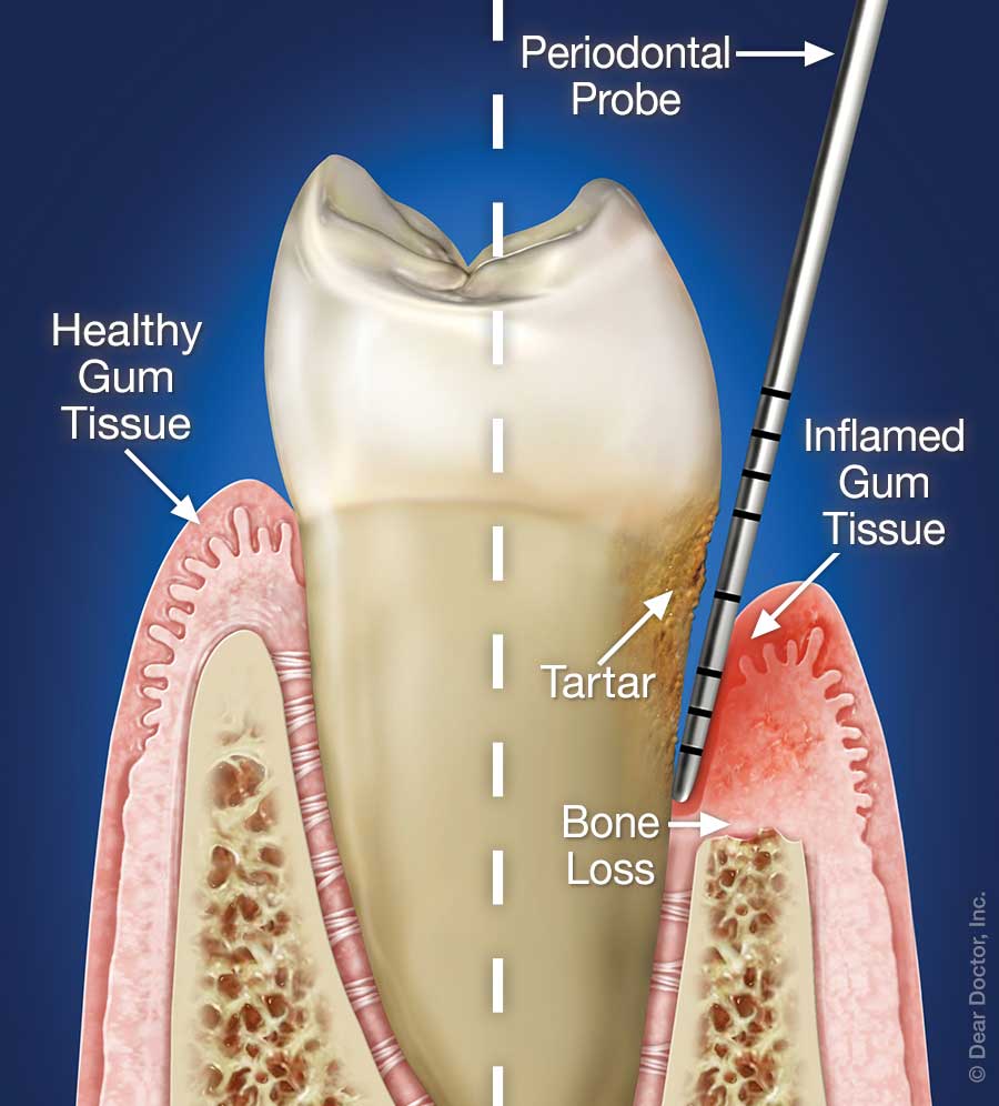 Periodontal Disease.